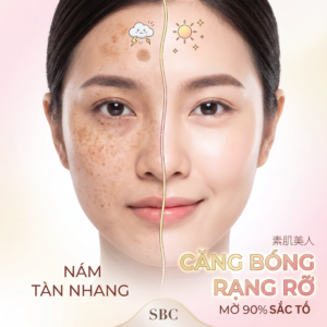Điều Trị Nám Tàn Nhang Tại SBC — Phác Đồ 3 Tầng Chuẩn Nhật 1 Điều Trị Nám Tàn Nhang Tại SBC