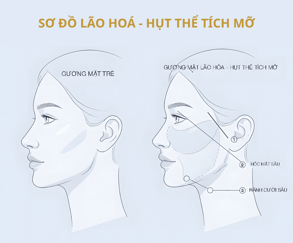 Ảnh minh hoạ: Sơ đồ y khoa các vùng lão hóa, hụt thể tích mỡ trên mặt: hóp thái dương, má hóp, hốc mắt sâu