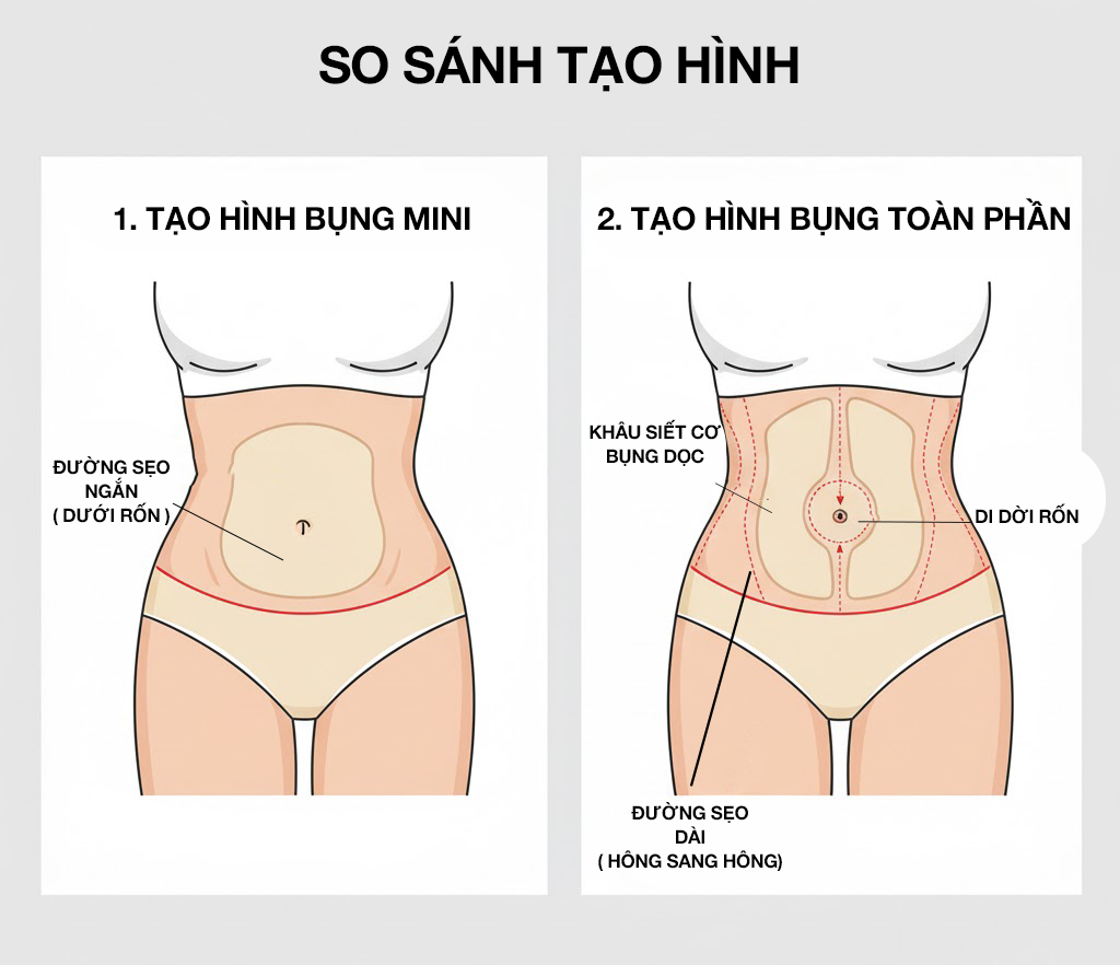 Sơ đồ y khoa so sánh kỹ thuật tạo hình thành bụng Mini và Full (Toàn phần)