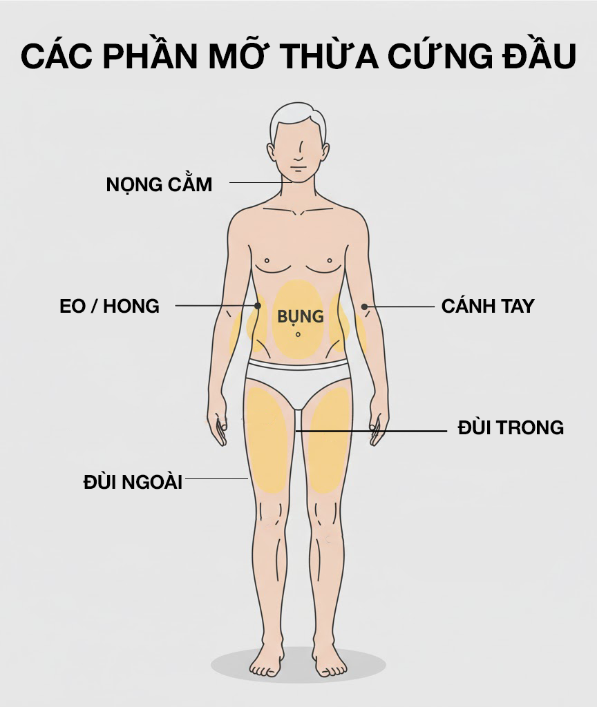  Sơ đồ các vùng mỡ thừa cứng đầu trên cơ thể: bụng, eo, đùi, cánh tay, nọng cằm