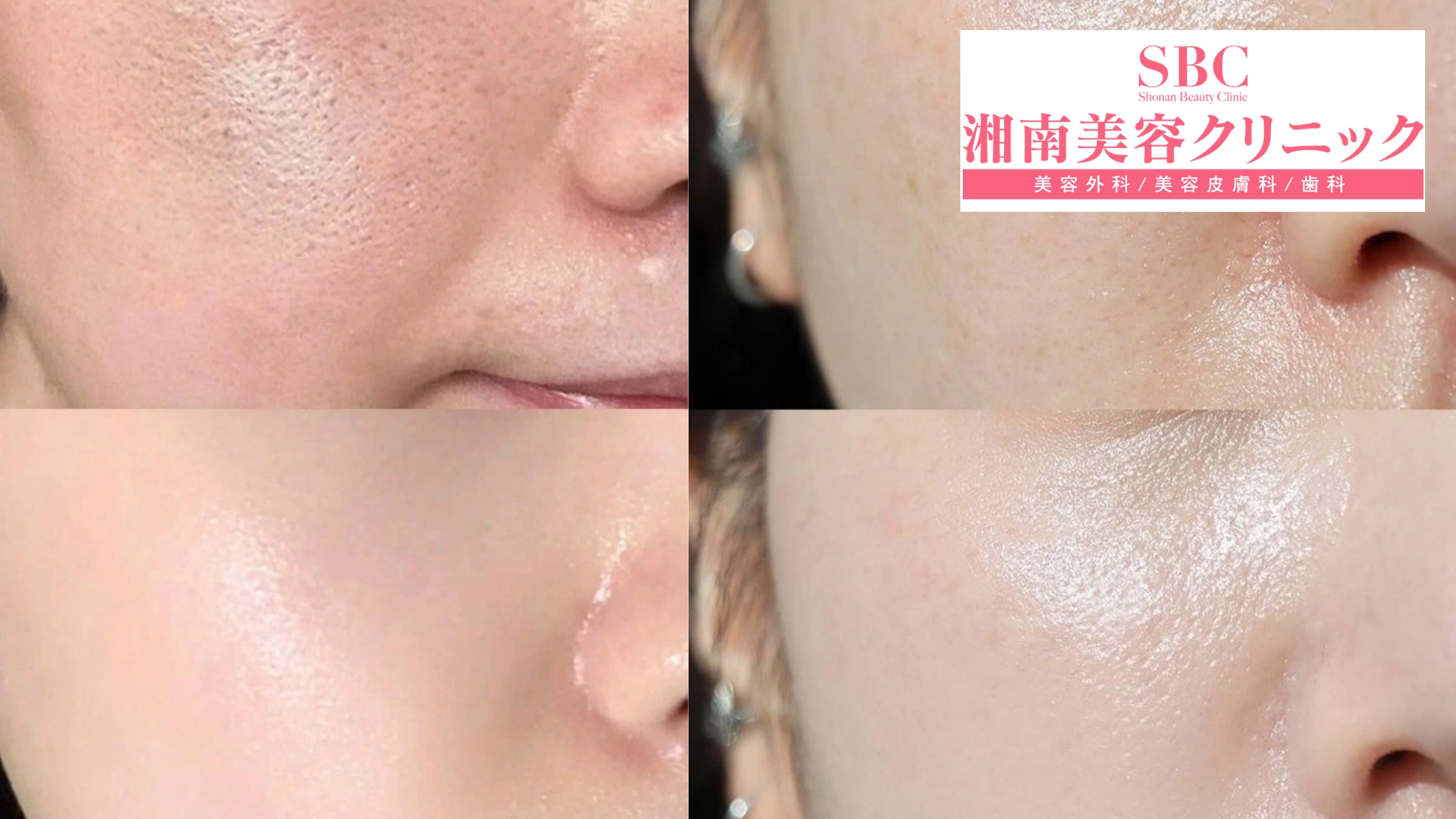 Vi kim RF Sylfirm X tại SBC: Bảng giá & Thông tin chi tiết 11 Hình ảnh khách hàng trước và sau liệu trình Sylfirm X (before - after 6)
