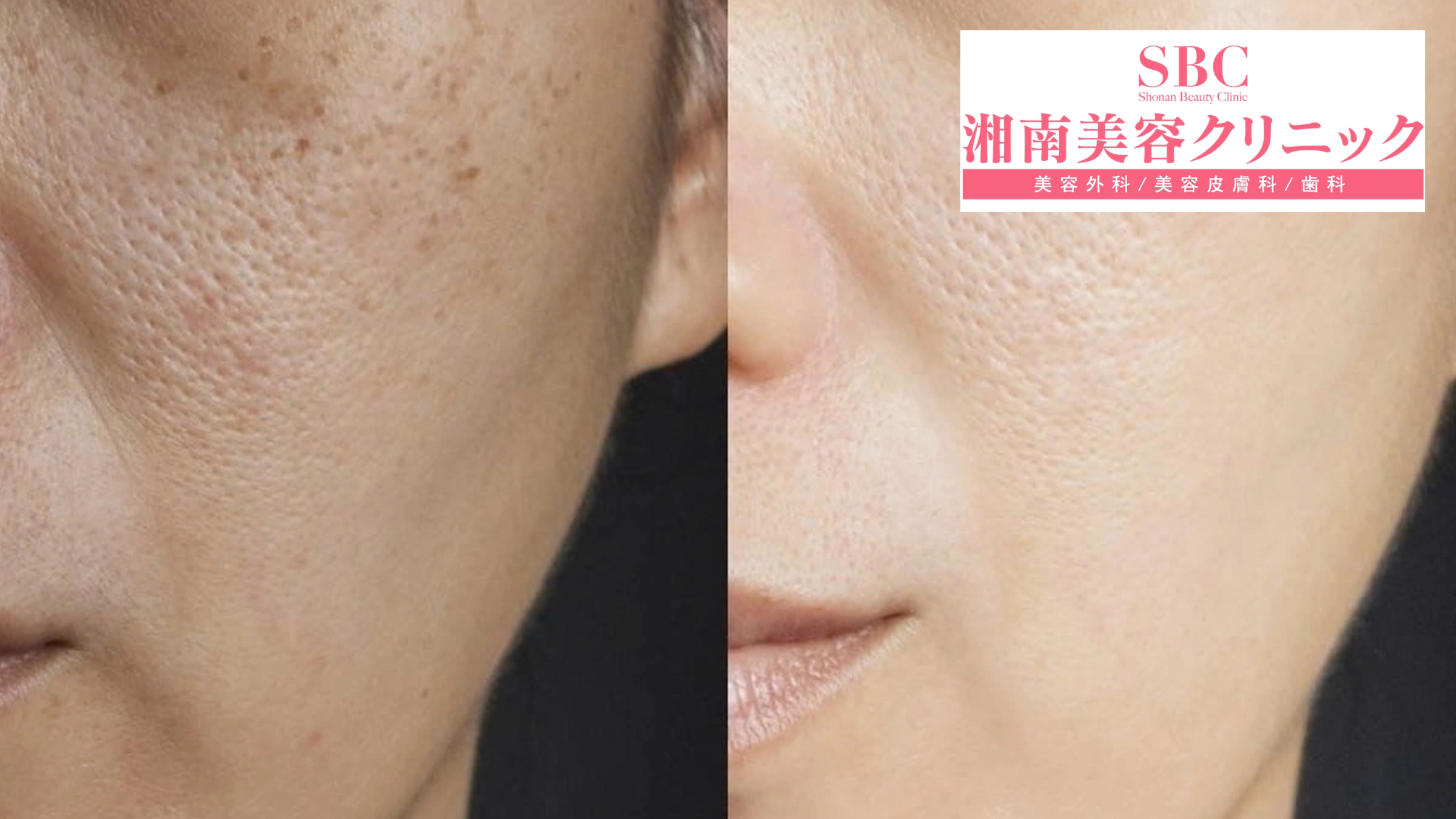 Vi kim RF Sylfirm X tại SBC: Bảng giá & Thông tin chi tiết 12 Hình ảnh khách hàng trước và sau liệu trình Sylfirm X (before - after 7)
