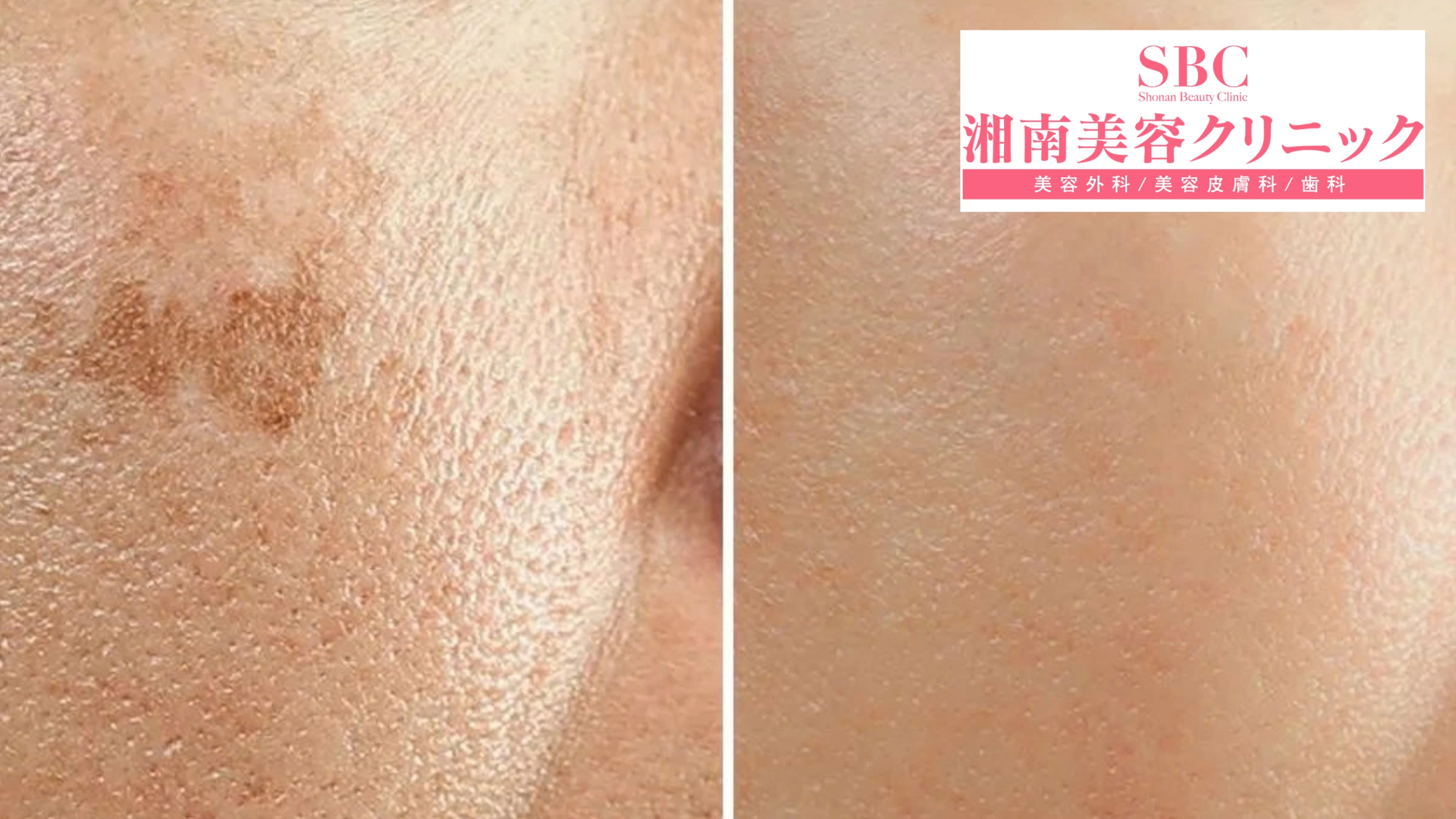 Vi kim RF Sylfirm X tại SBC: Bảng giá & Thông tin chi tiết 13 Hình ảnh khách hàng trước và sau liệu trình Sylfirm X (before - after 8)