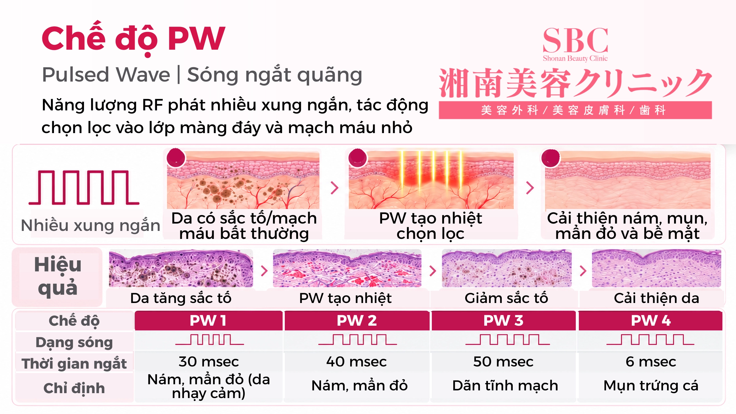 Vi kim RF Sylfirm X tại SBC: Bảng giá & Thông tin chi tiết 4 Cơ chế hoạt động của sóng liên tục PW hỗ trợ điều trị nám và mụn
