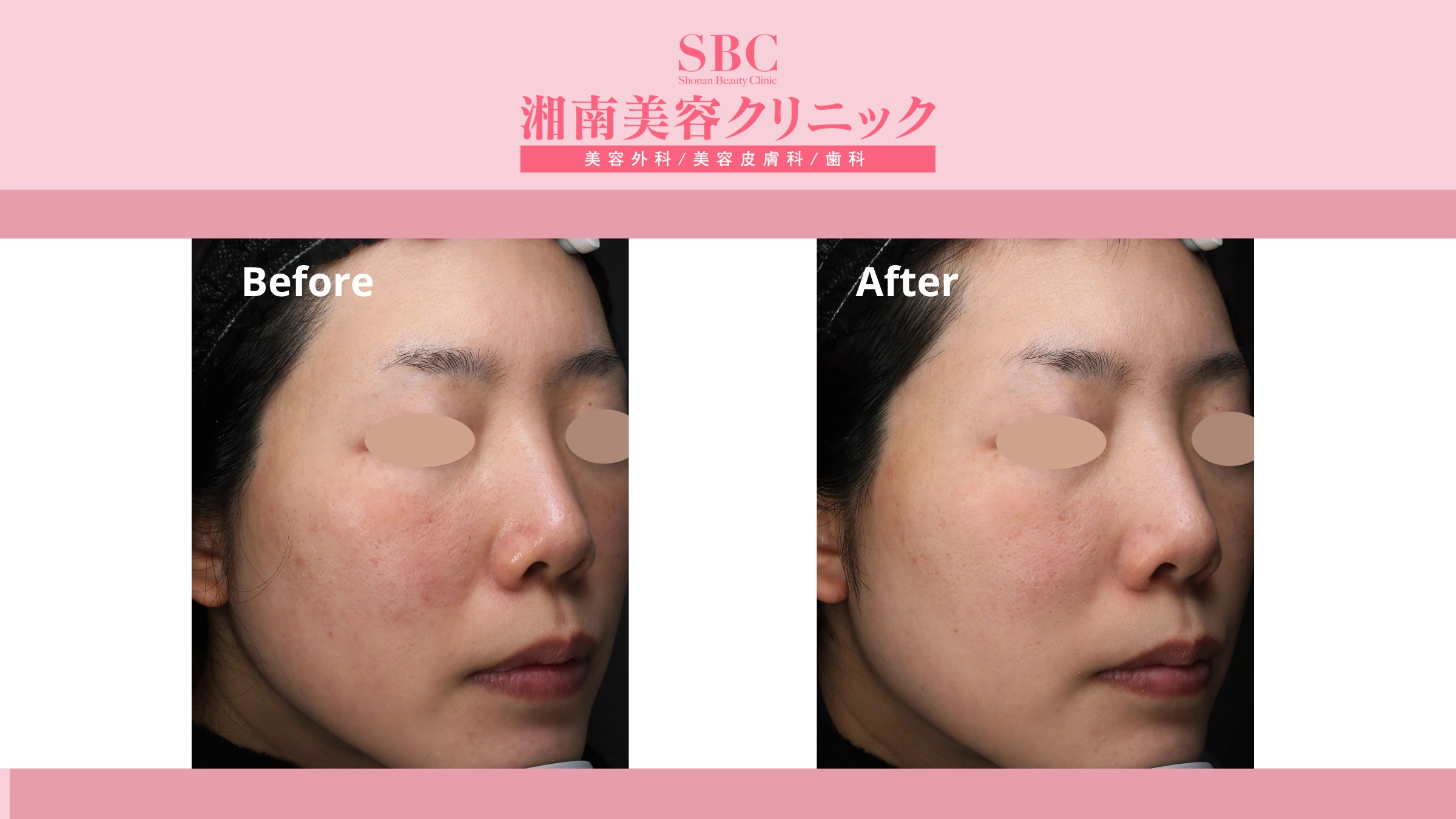 Vi kim RF Sylfirm X tại SBC: Bảng giá & Thông tin chi tiết 6 Hình ảnh khách hàng trước và sau liệu trình Sylfirm X (before - after 1)