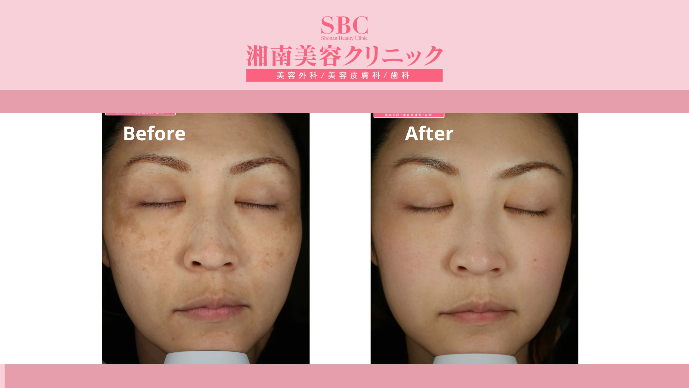 Vi kim RF Sylfirm X tại SBC: Bảng giá & Thông tin chi tiết 7 Hình ảnh khách hàng trước và sau liệu trình Sylfirm X (before - after 2)