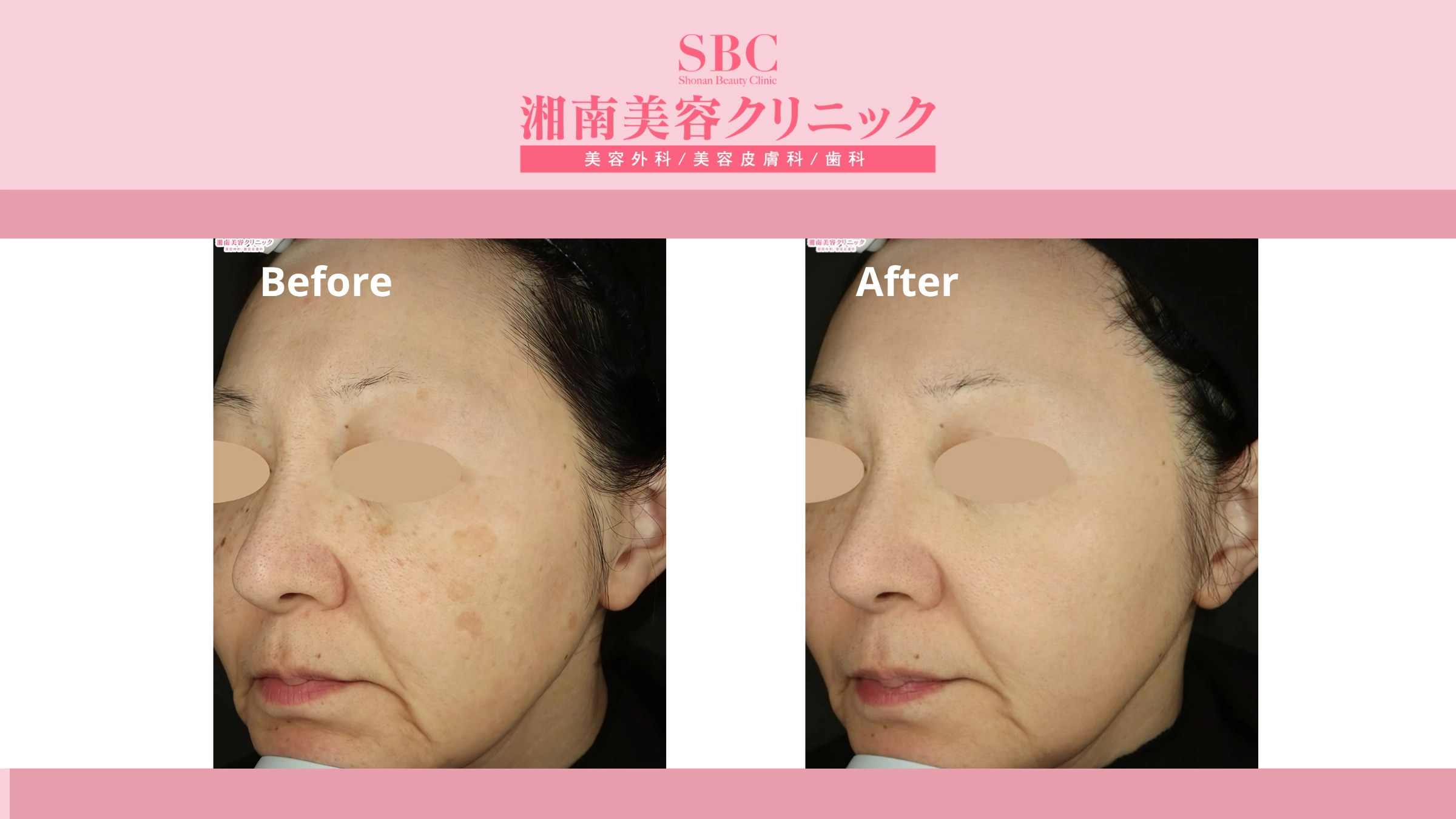 Vi kim RF Sylfirm X tại SBC: Bảng giá & Thông tin chi tiết 8 Hình ảnh khách hàng trước và sau liệu trình Sylfirm X (before - after 3)