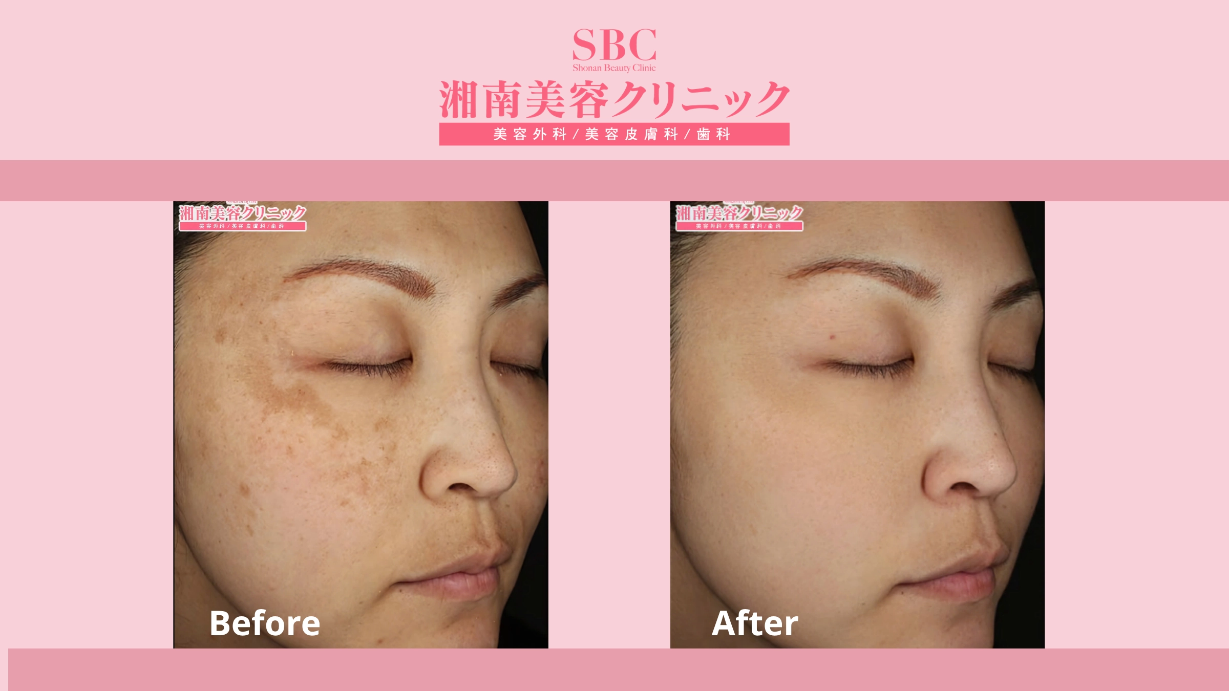 Vi kim RF Sylfirm X tại SBC: Bảng giá & Thông tin chi tiết 9 Hình ảnh khách hàng trước và sau liệu trình Sylfirm X (before - after 4)