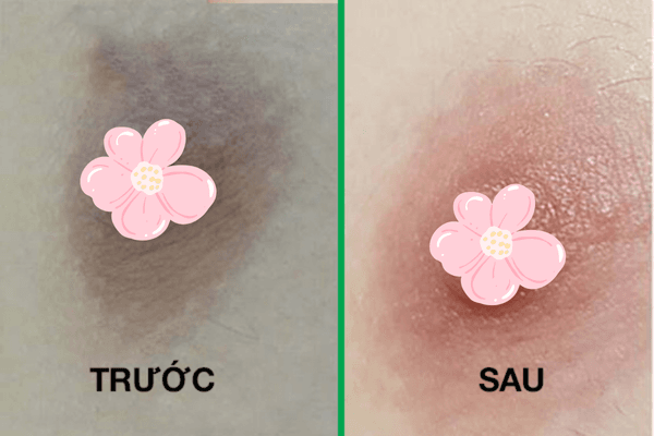 Hình ảnh trước và sau phẫu thuật thu nhỏ quầng nhũ hoa và đầu ti tại Viện thẩm mỹ SBC