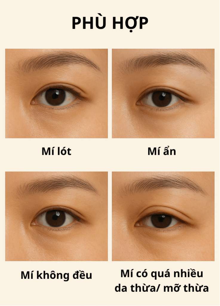 Nhấn mí Forever - Bí quyết đôi mắt trẻ trung tại SBC 4 Các trường hợp mắt phù hợp và không phù hợp với nhấn mí Forever