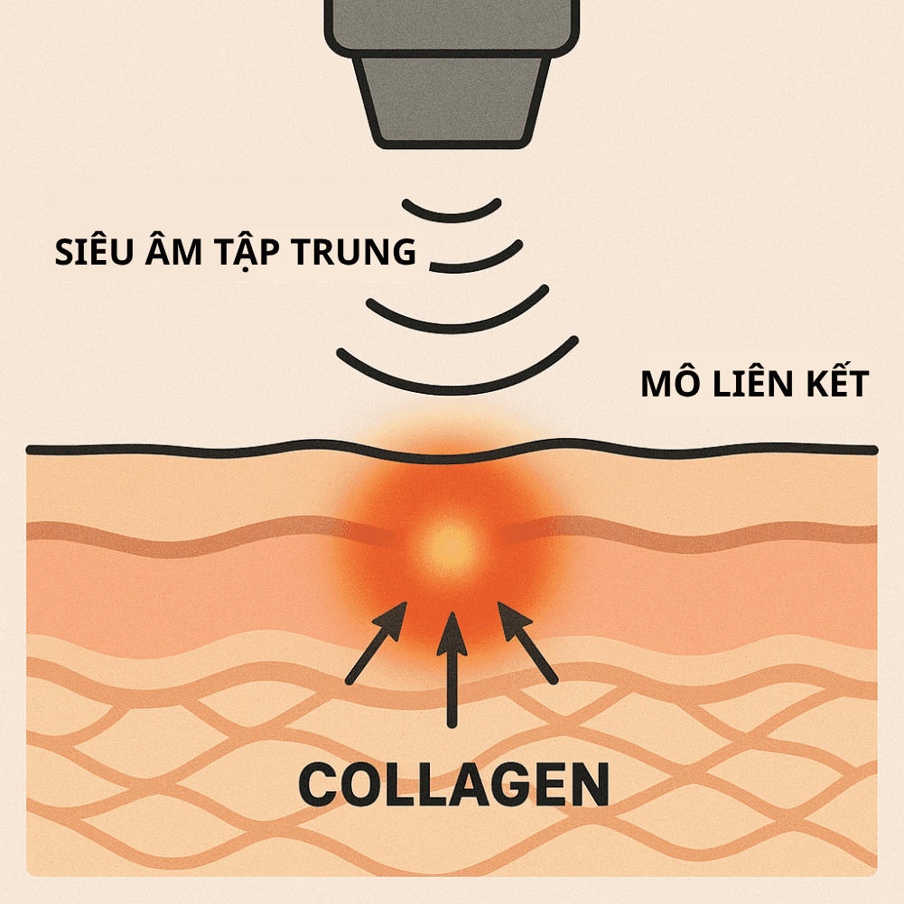 Thon gọn mặt: Giải pháp định hình đường viền tại SBC 7 Ảnh minh hoạ: Đồ họa cơ chế hoạt động của công nghệ HIFU/Ultherapy