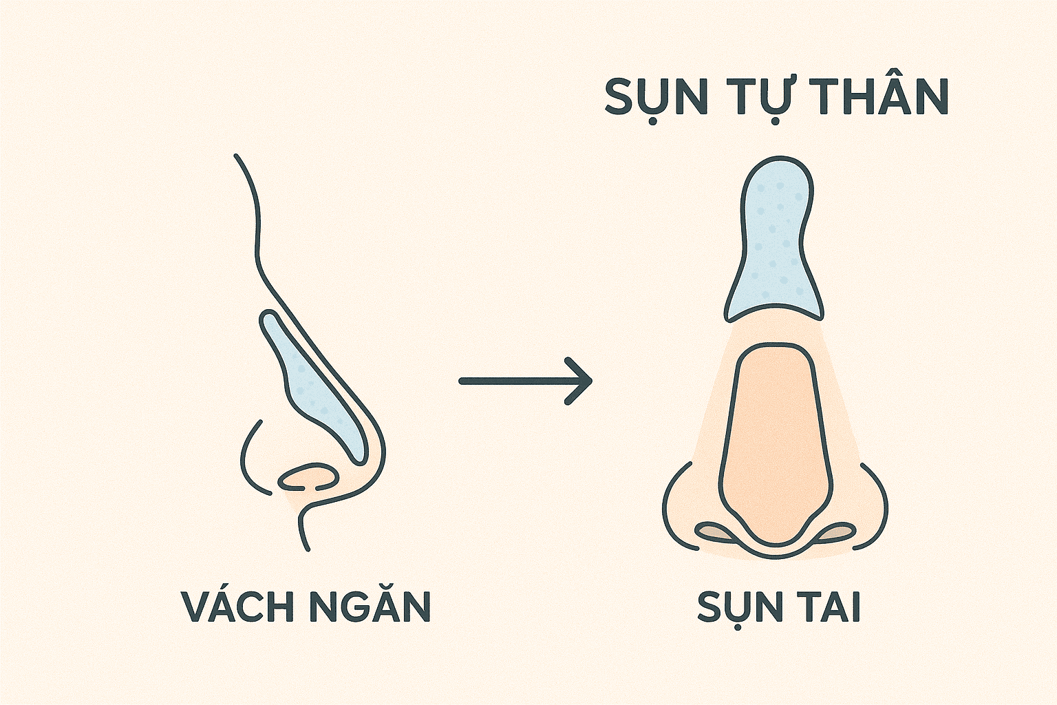 Nâng Mũi Sụn Surgiform: Dáng Mũi Tự Nhiên & Bền Vững 6 Ảnh minh hoạ: Đồ họa minh họa kết hợp sụn Surgiform và sụn tự thân trong nâng mũi