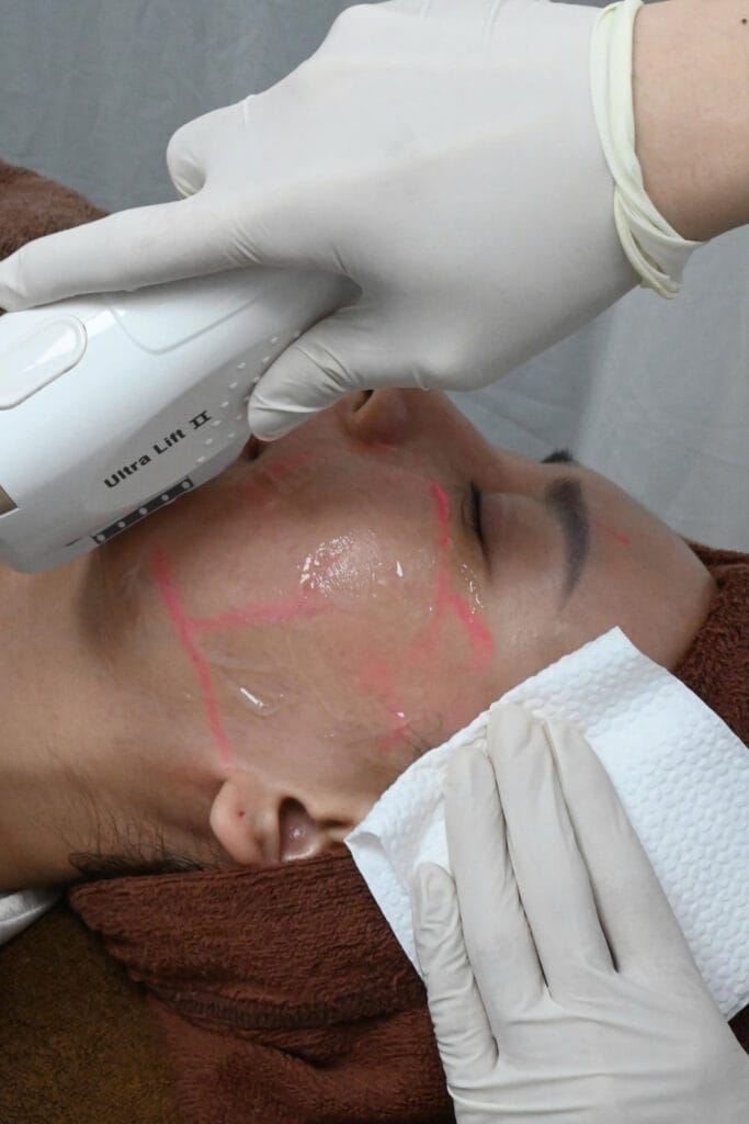 Khách hàng đang thực hiện trẻ hóa da bằng công nghệ cao Ultra Double Lift