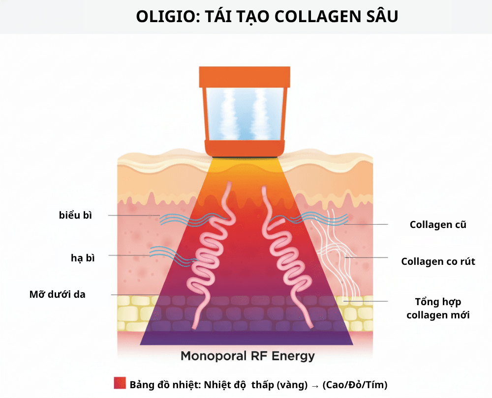 Đồ họa cơ chế sóng RF đơn cực của Oligio kích thích collagen