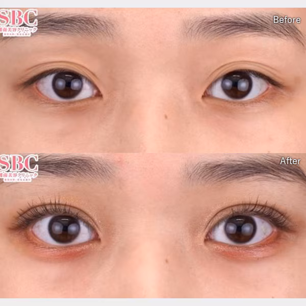 Ảnh Before-After cắt mí tự nhiên 2025 giúp đôi mắt to rõ tại Viện thẩm mỹ SBC