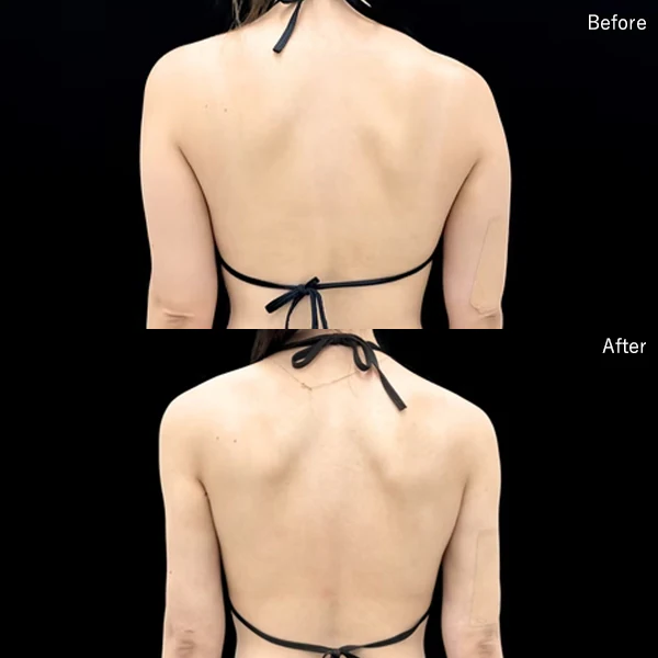 Ảnh Before-After hút mỡ tạo dáng vóc dáng thon gọn