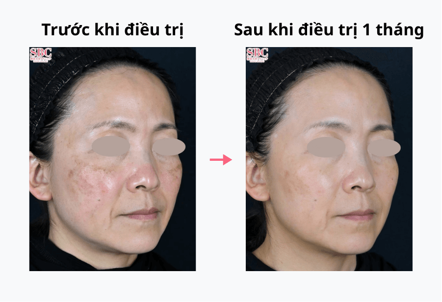 Kết quả trước và sau khi điều trị trẻ hóa da bằng Sylfirm X.