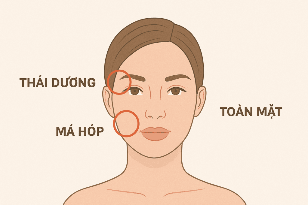 Sơ đồ khuôn mặt Đánh dấu các vùng cấy mỡ lớn thái dương, má hóp, toàn mặt