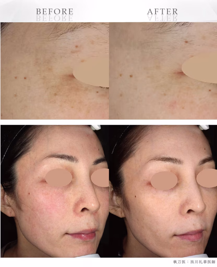 Kết quả trẻ hoá se khít lổ chân lông bằng vi kim RF