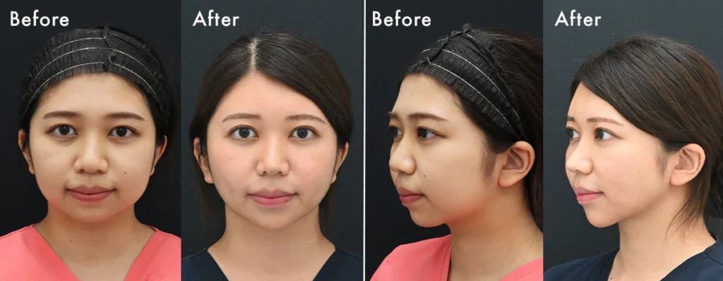 Hình ảnh thực tế từ khách hàng: Sau khi làm liệu trình nâng cơ Hifu tại SBC