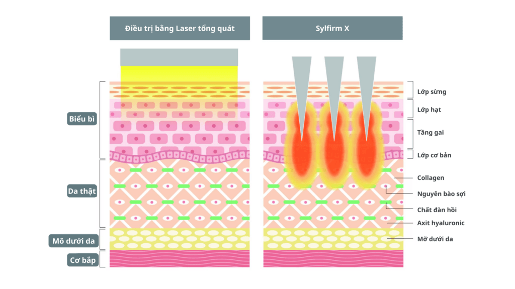 Infographic mô phỏng cơ chế Vi kim RF thế hệ mới: Năng lượng tập trung vào trung bì, không gây tổn thương bề mặt da.