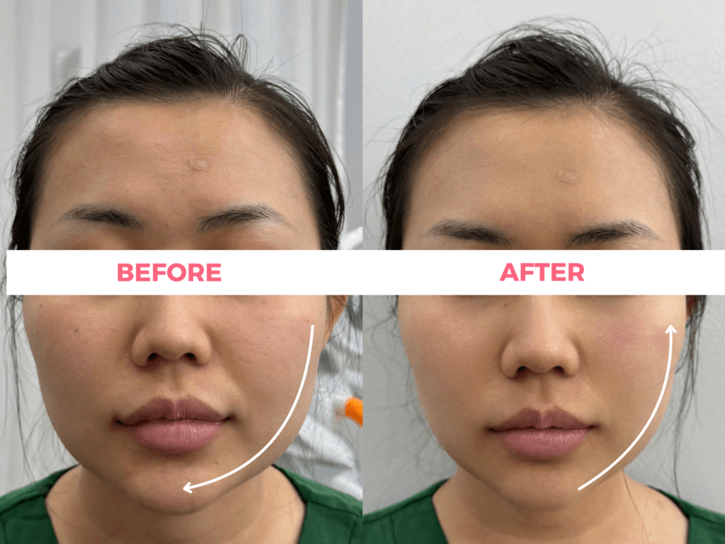 Ảnh khách hàng ngay sau khi điều trị Ultraformer MPT