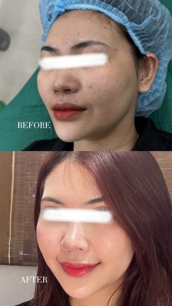 Hiệu quả cải thiện sẹo rỗ và trẻ hóa da sau liệu trình PRP tại SBC.