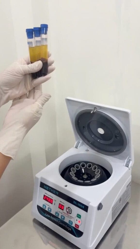 Lớp Buffy Coat chứa nồng độ tiểu cầu cao nhất trong quy trình chiết tách PRP.