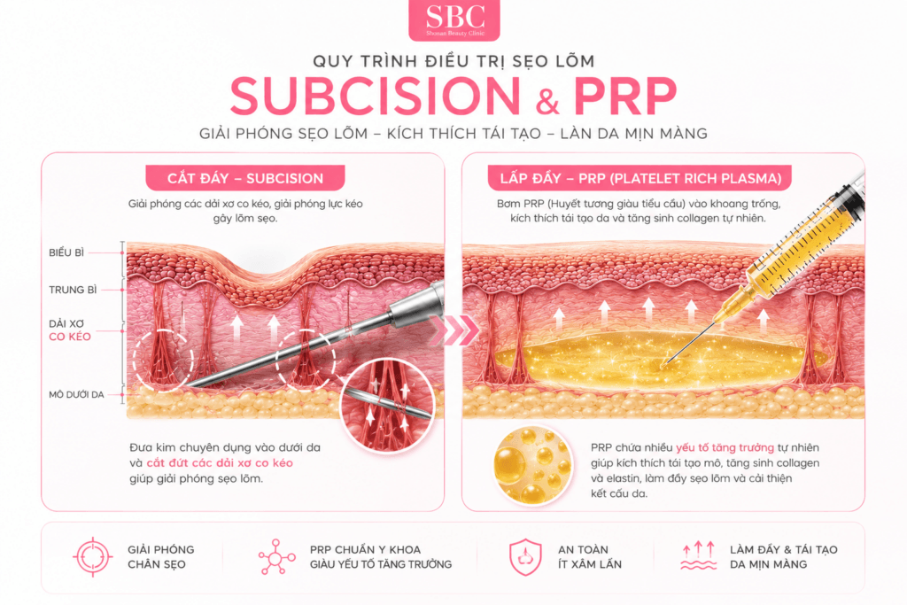 Các Phương Pháp Điều Trị Sẹo Rỗ Chuẩn Y Khoa Hiệu Quả 5 Infographic Subcision và PRP chuẩn y khoa điều trị sẹo rỗ tại SBC.