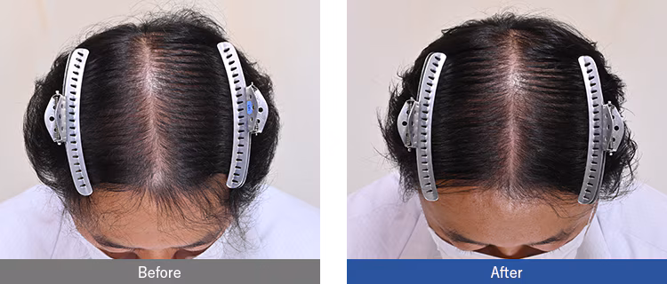 Tiêm PRP trị rụng tóc có hiệu quả không? Giá bao nhiêu? 4 Khách hàng nữ phục hồi độ dày đường ngôi giữa thành công chỉ sau 3 tháng (2 buổi tiêm C-PRP) tại SBC.