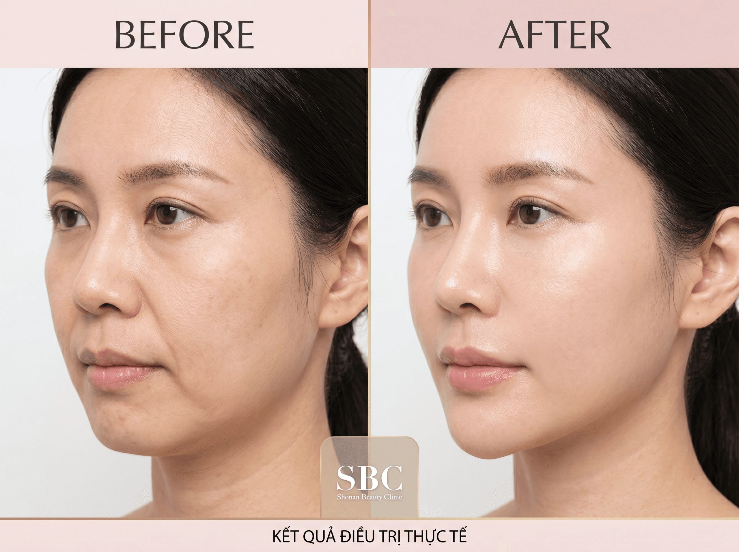 Tiêm Filler Khuôn Mặt – Chỉnh Hình Tự Nhiên, An Toàn Tại SBC 6 Kết quả thực tế trước và sau khi tiêm filler làm đầy rãnh cười và cân đối dáng cằm V-line tại SBC.
