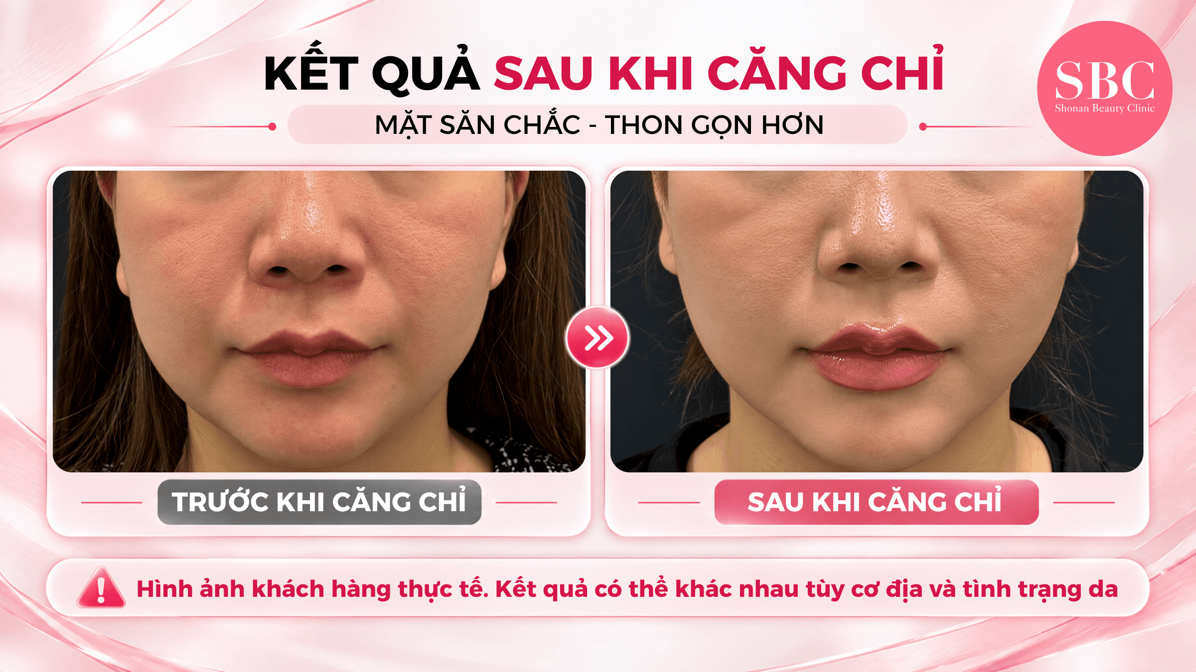 Căng chỉ nâng cơ tại SBC: Bảng giá & Thông tin chi tiết 13 Kết quả của khách hàng trước và sau khi căng chỉ tại SBC