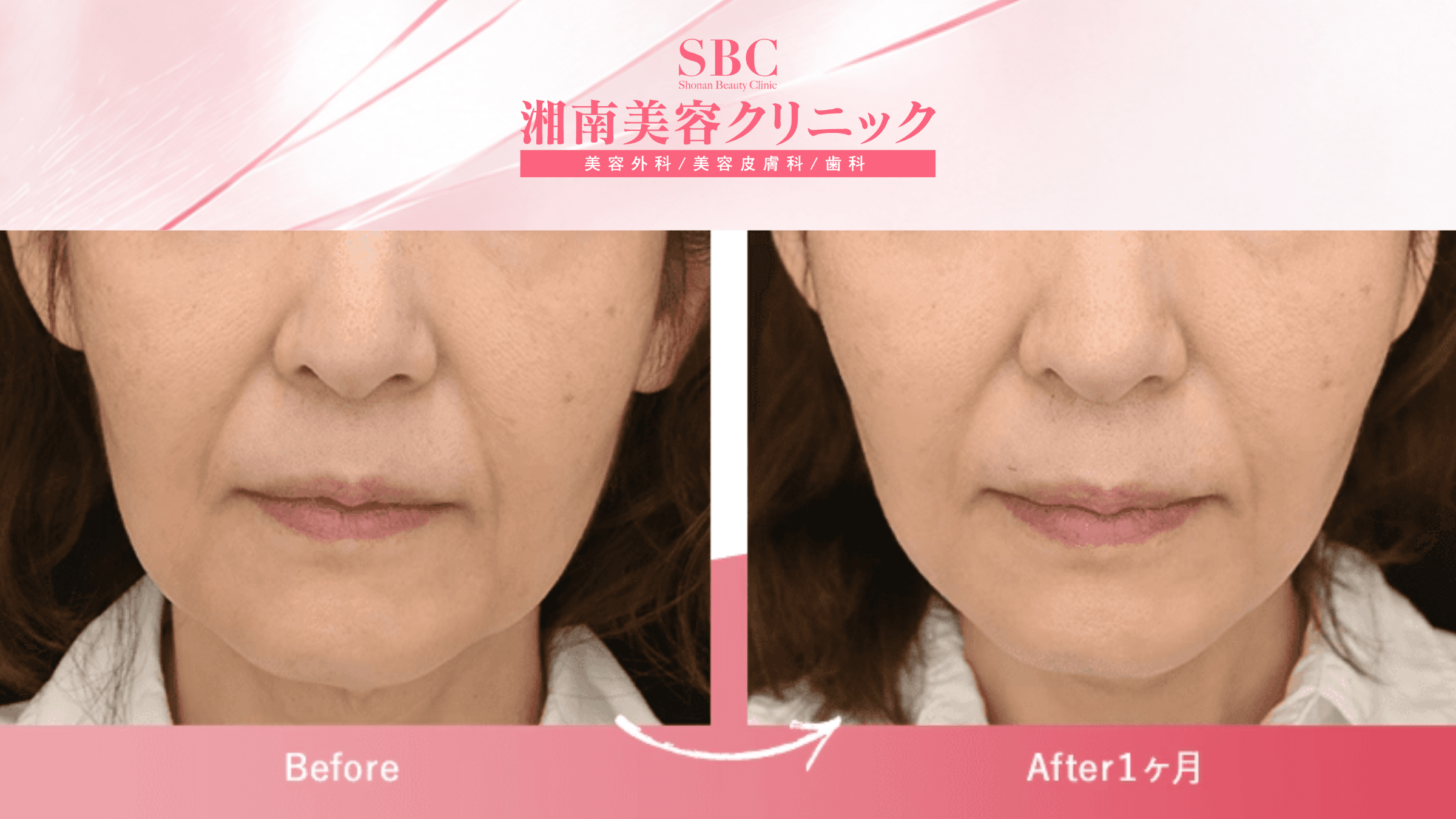 Căng chỉ nâng cơ tại SBC: Bảng giá & Thông tin chi tiết 7 Ảnh kết quả trước và sau khi căng chỉ tại SBC (before - after 2)