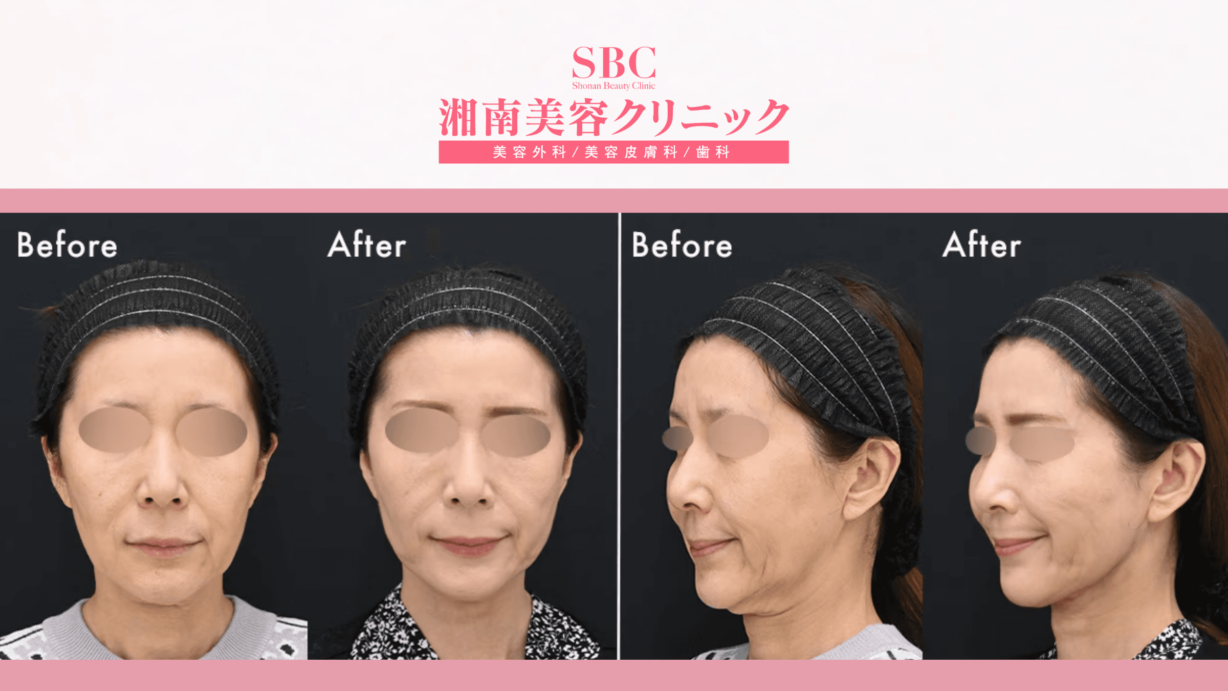 Nâng cơ & trẻ hóa kết hợp tại SBC: Bảng giá & Thông tin chi tiết 9 Hình ảnh trước và sau khi nâng cơ & trẻ hóa kết hợp tại SBC (before - after 5)