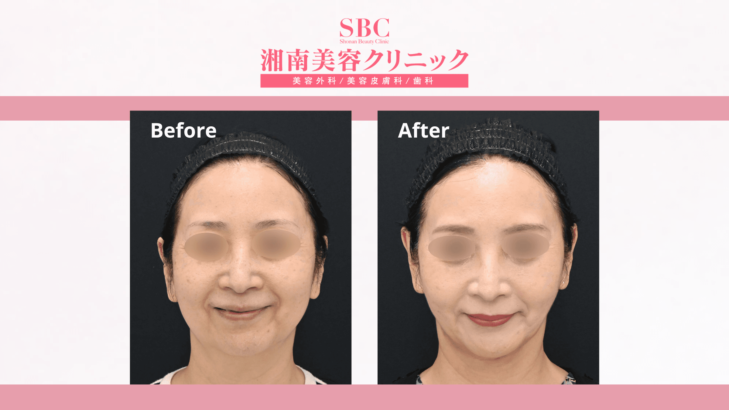 Nâng cơ & trẻ hóa kết hợp tại SBC: Bảng giá & Thông tin chi tiết 10 Hình ảnh trước và sau khi nâng cơ & trẻ hóa kết hợp tại SBC (before - after 6)