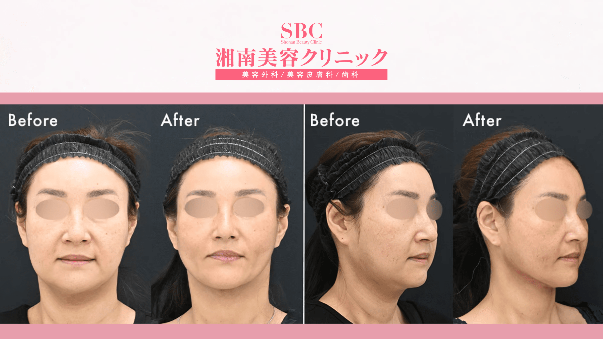 Nâng cơ & trẻ hóa kết hợp tại SBC: Bảng giá & Thông tin chi tiết 7 Hình ảnh trước và sau khi nâng cơ & trẻ hóa kết hợp tại SBC (before - after 3)