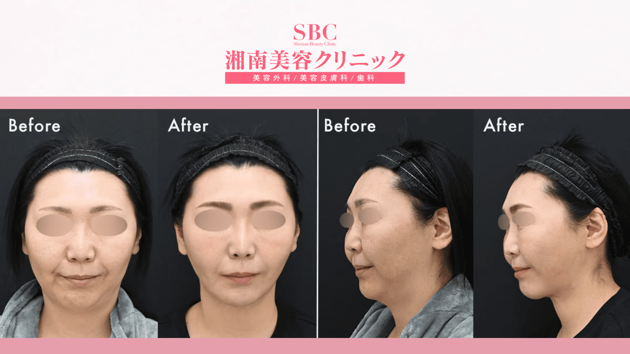 Nâng cơ & trẻ hóa kết hợp tại SBC: Bảng giá & Thông tin chi tiết 8 Hình ảnh trước và sau khi nâng cơ & trẻ hóa kết hợp tại SBC (before - after 4)