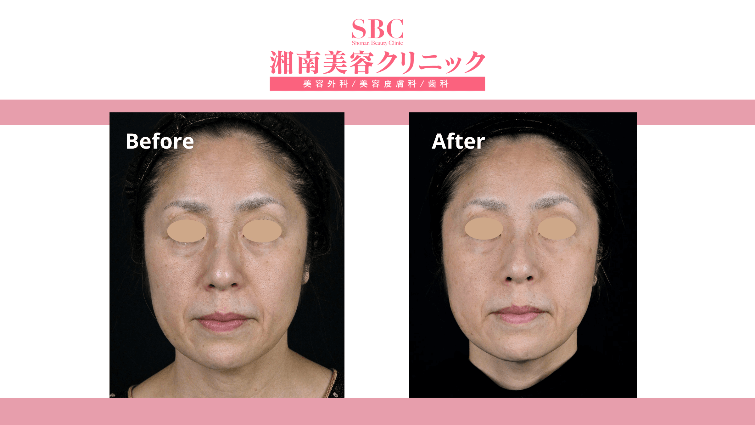 Tiêm trẻ hóa da tại SBC: Bảng giá & Thông tin chi tiết về dịch vụ 8 Hình ảnh khách hàng trước và sau khi tiêm trẻ hóa tại SBC (before - after 1)