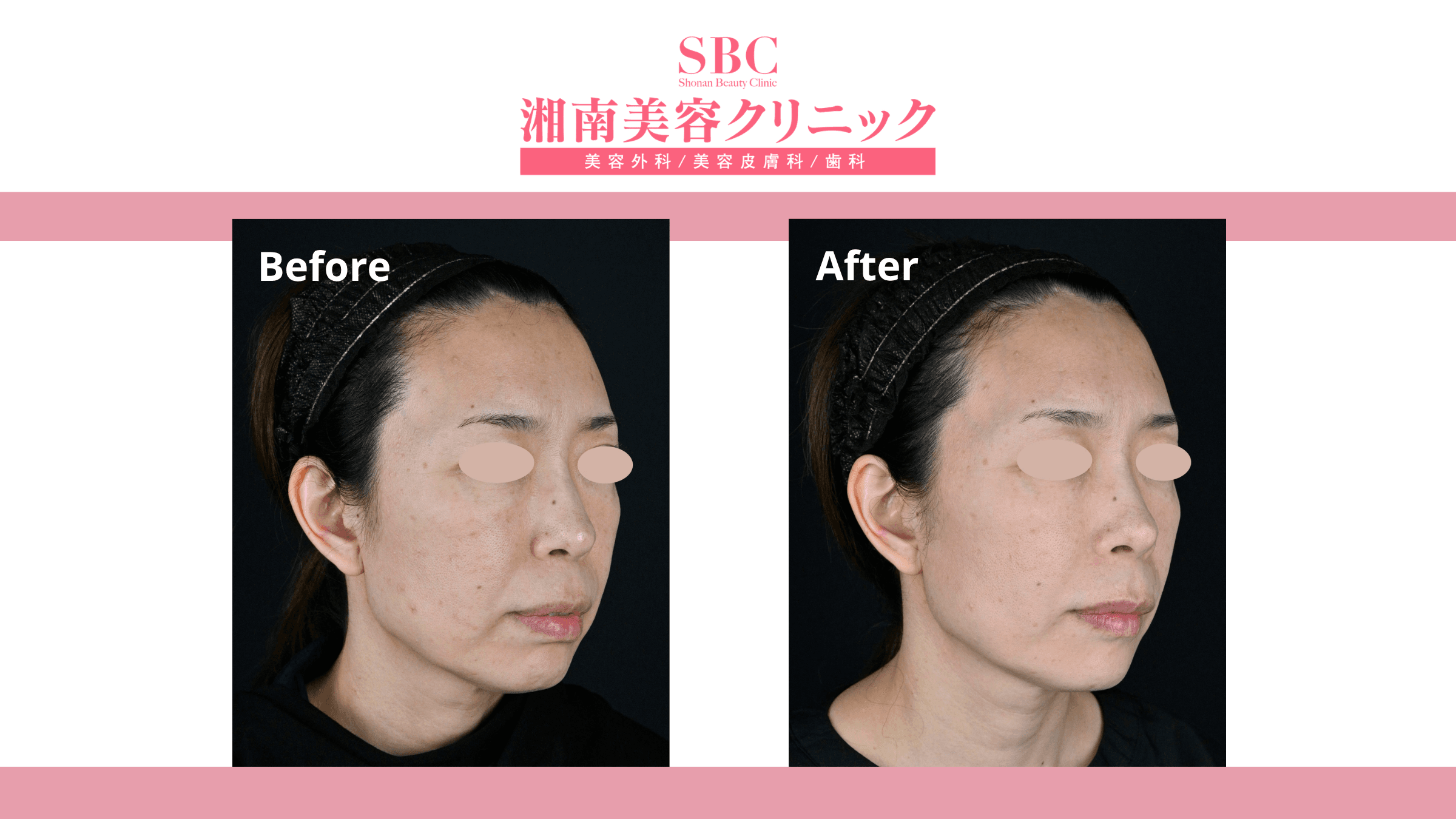 Tiêm trẻ hóa da tại SBC: Bảng giá & Thông tin chi tiết về dịch vụ 9 Hình ảnh khách hàng trước và sau khi tiêm trẻ hóa tại SBC (before - after 2)